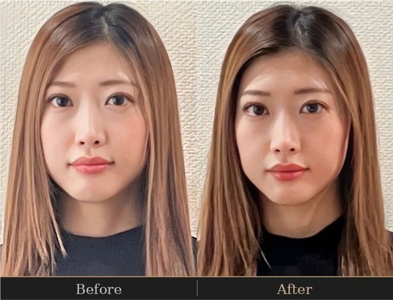 Before and after - reduced puffiness and lifted face line